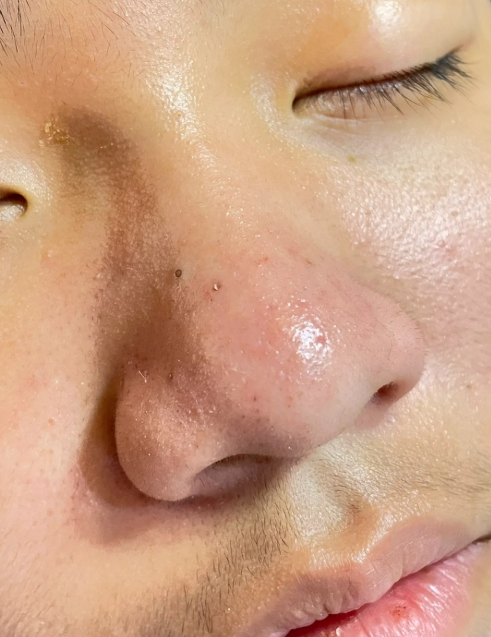 脸上有黑点点怎么去除?