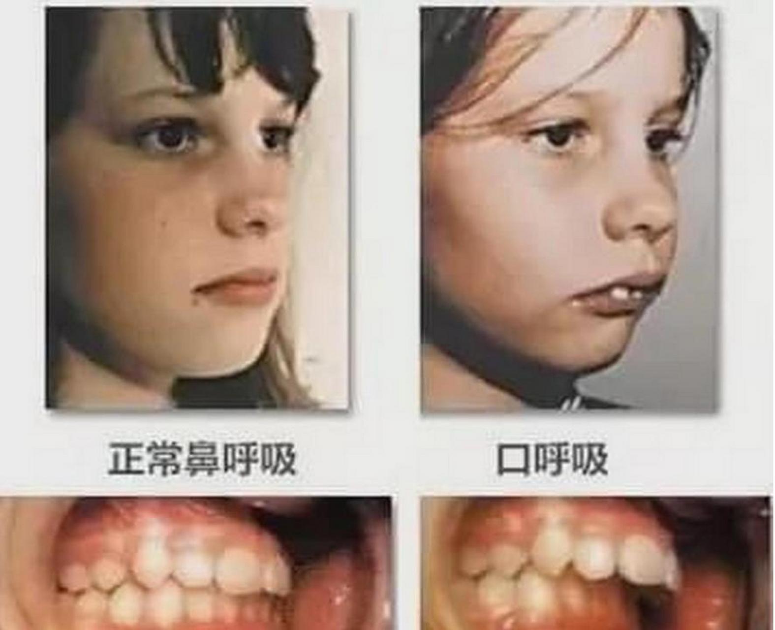 嗯哼近照疑腺样体面容引网友担心# 孩子睡觉的一个小毛病不仅影响