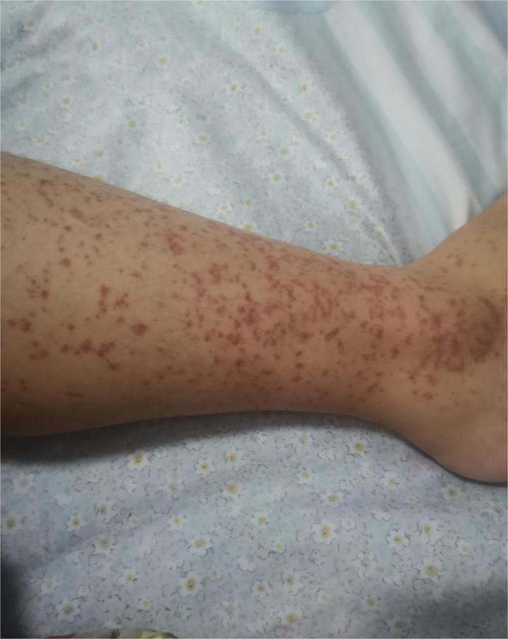 1过敏性紫癜一直反复发作的患者,可以通过中医方法进行治疗,除了服用