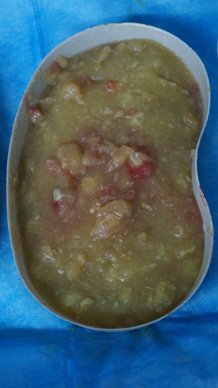 奥美定隆胸后,出现了硬块,注射物体移位,经常疼痛并且出现感染者,是