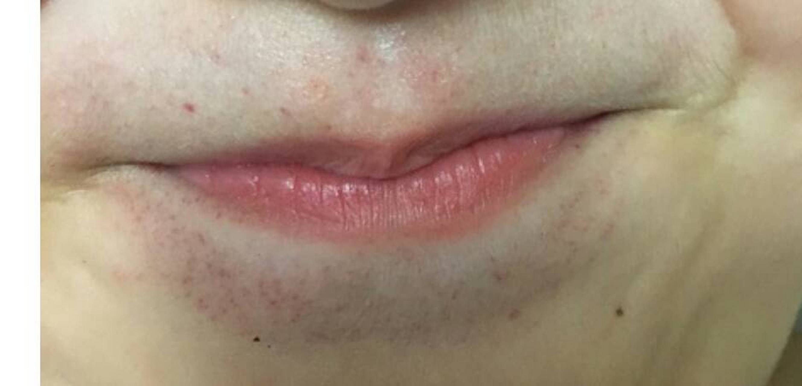 嘴角长湿疹是什么原因?