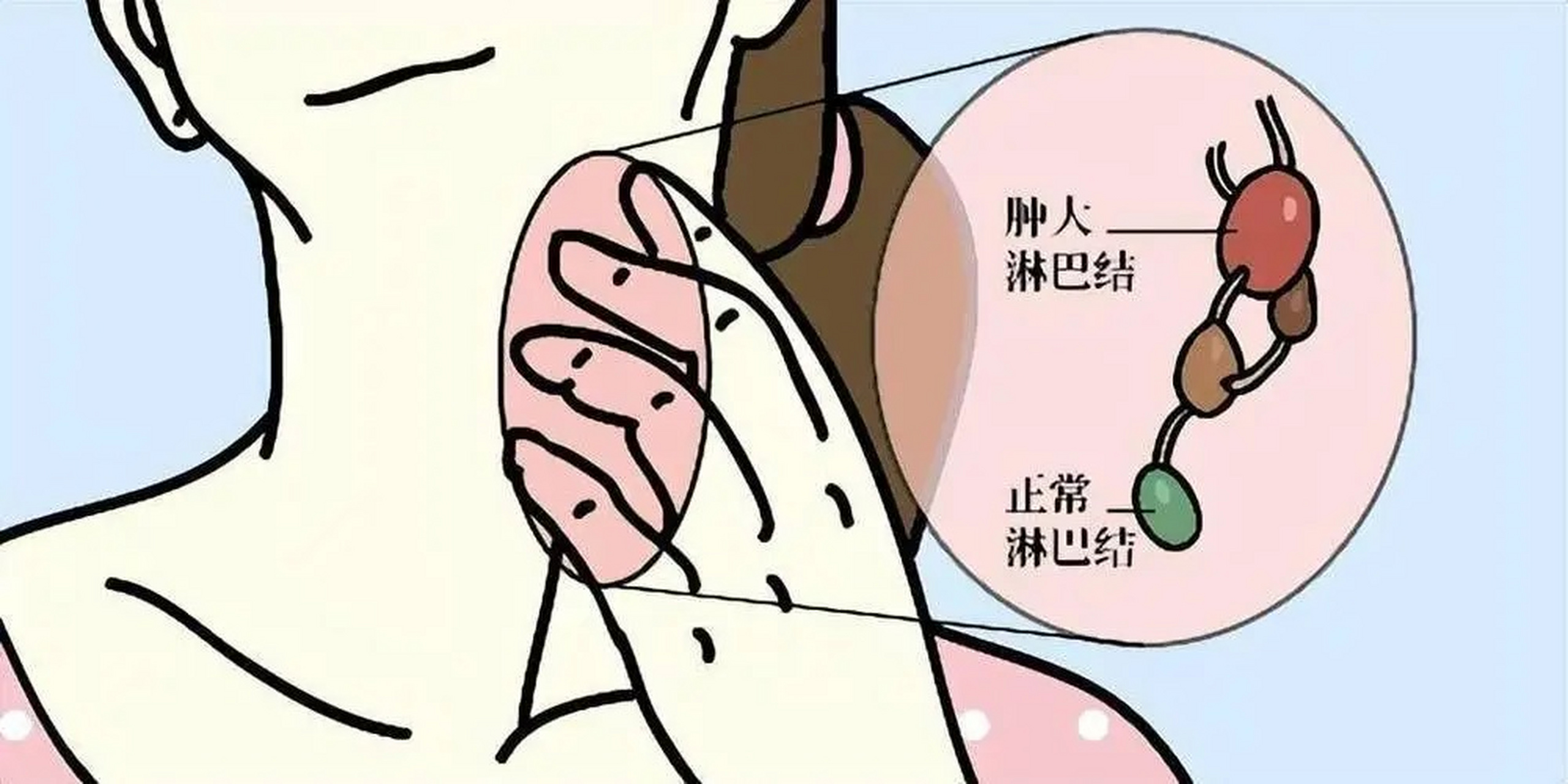 有淋巴瘤的朋友们,留下这四个问题的答案,我来帮助你,给你分析解答.