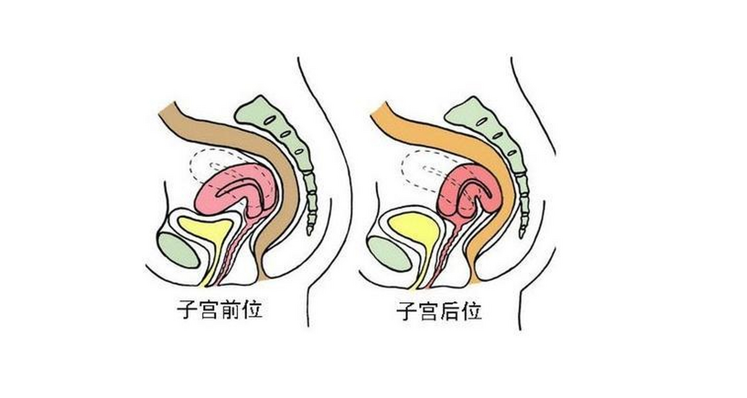 子宫前位正确受孕图解图片