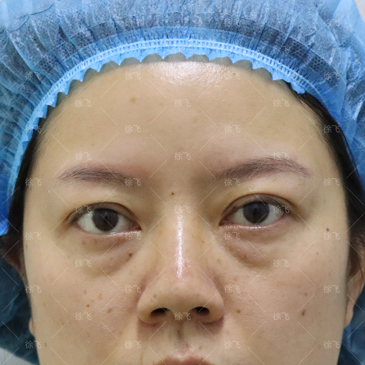 给大家分享一个不开刀微创去眼袋泪沟的案例 这位女士32岁,眼袋脂肪