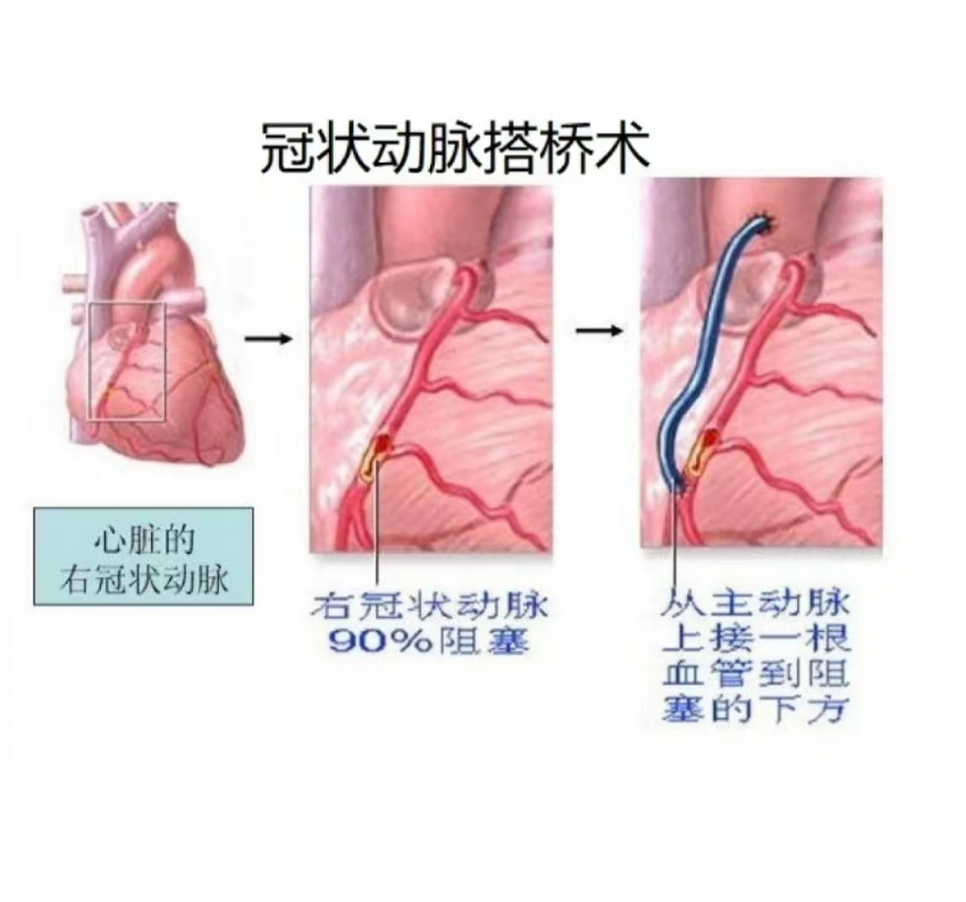 心脏支架从哪里放进去图片