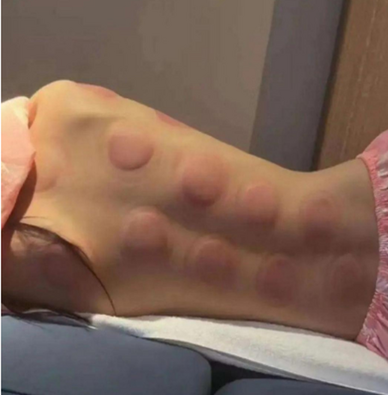 再好看的后背,拔罐之后也是一样的.