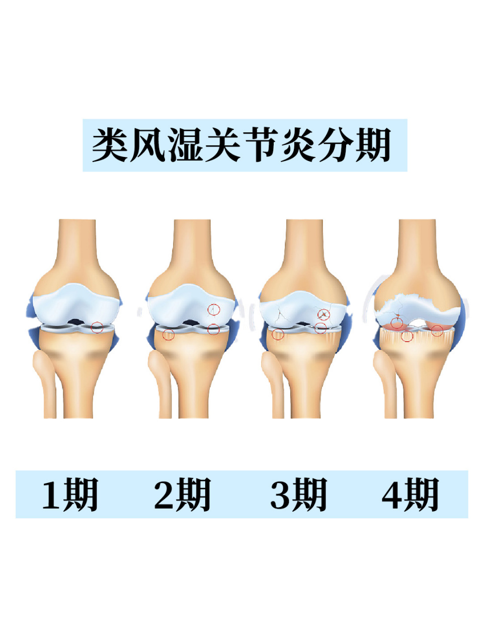 风湿性关节炎图图片