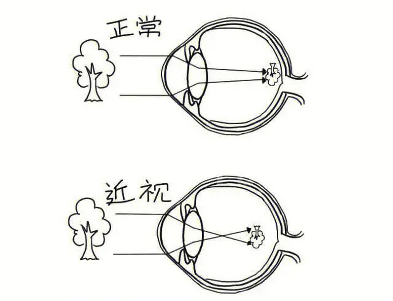 [你懂的]  所以激光近视手术,也叫角膜屈光手术.