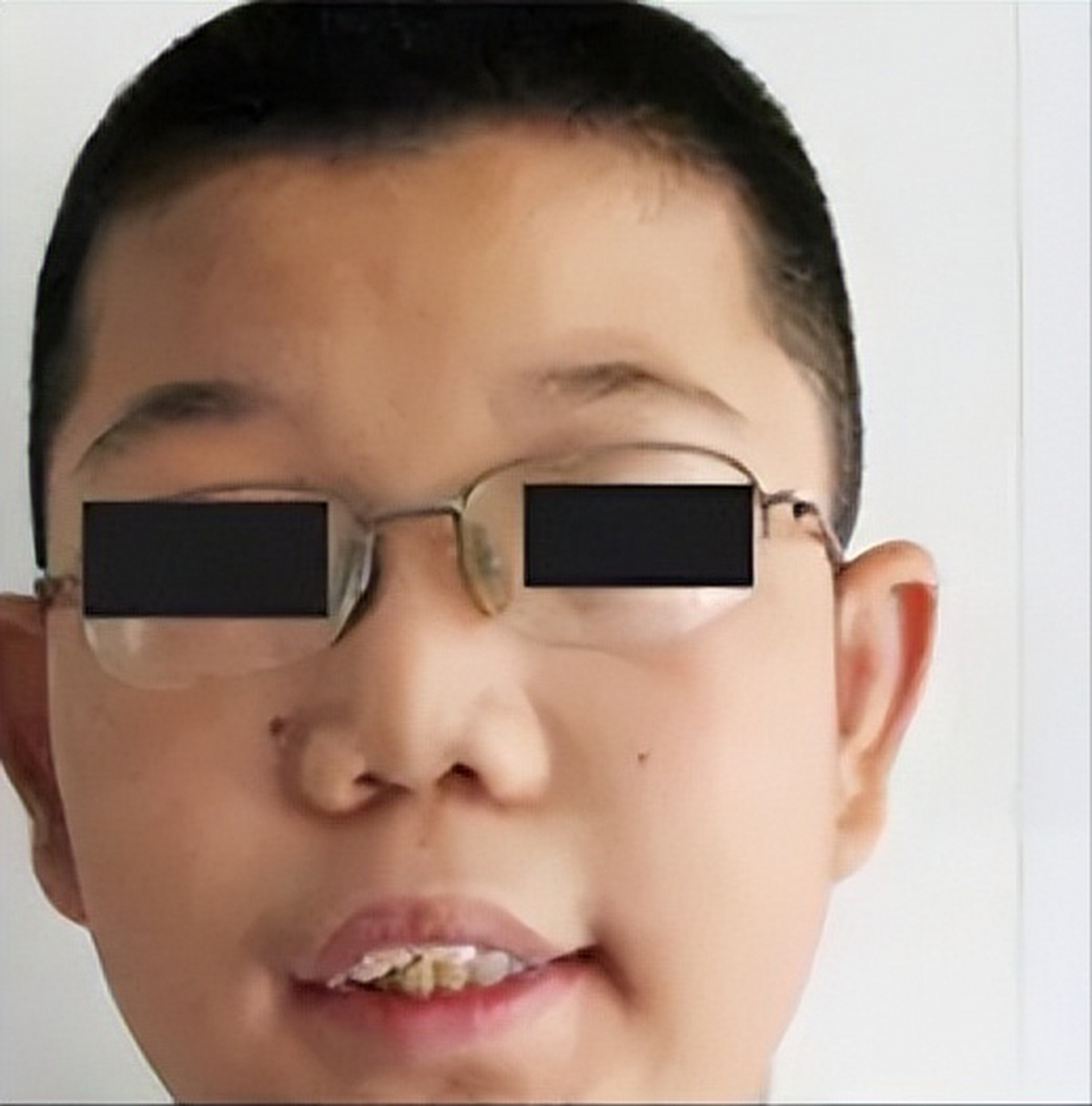 家人长得一点也不像,龅牙,长脸厚唇,于是撺掇儿子偷偷去做亲子鉴定