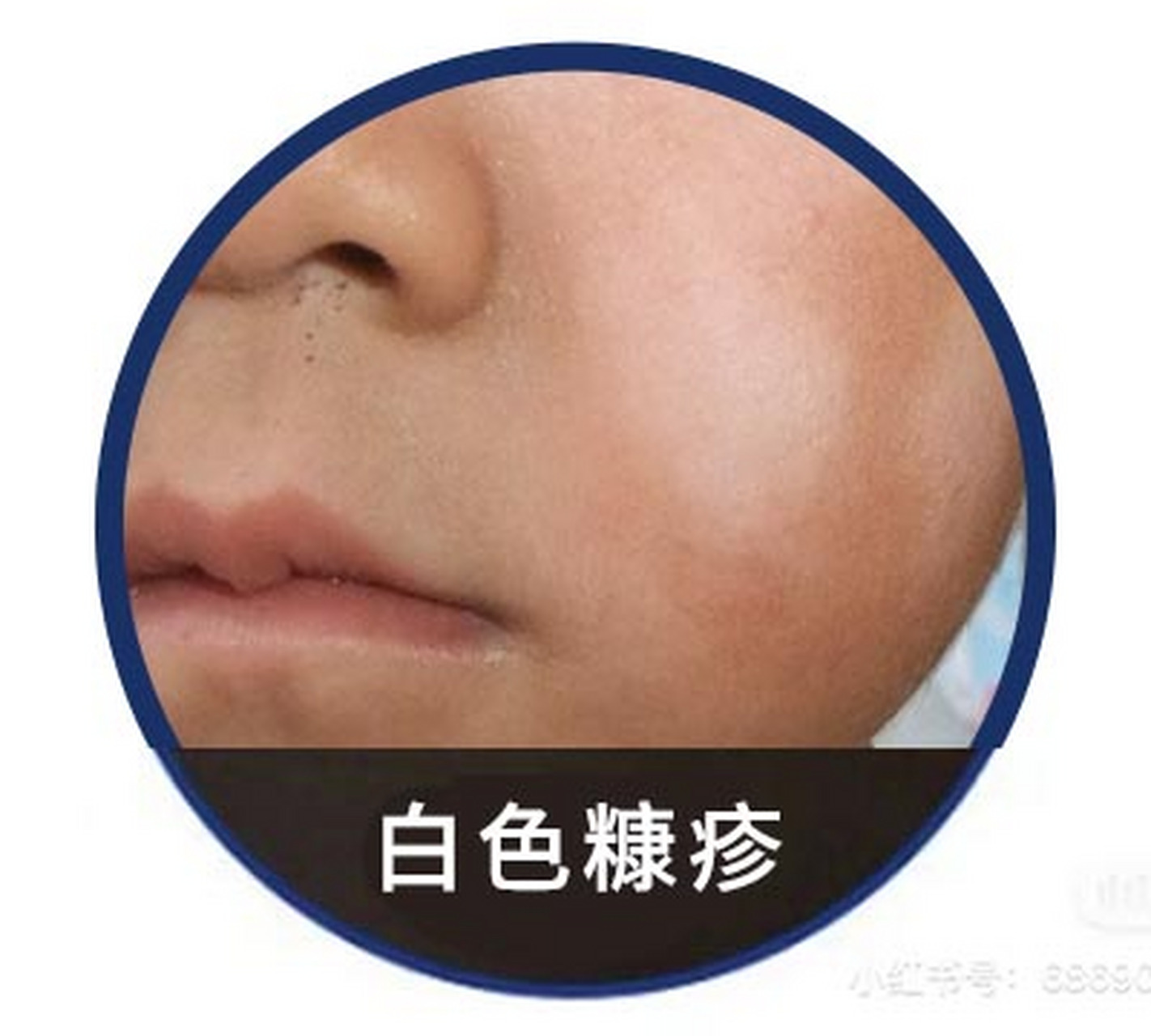 小孩脸上长白斑是白癜风吗,不一定,可能是白色糠疹!