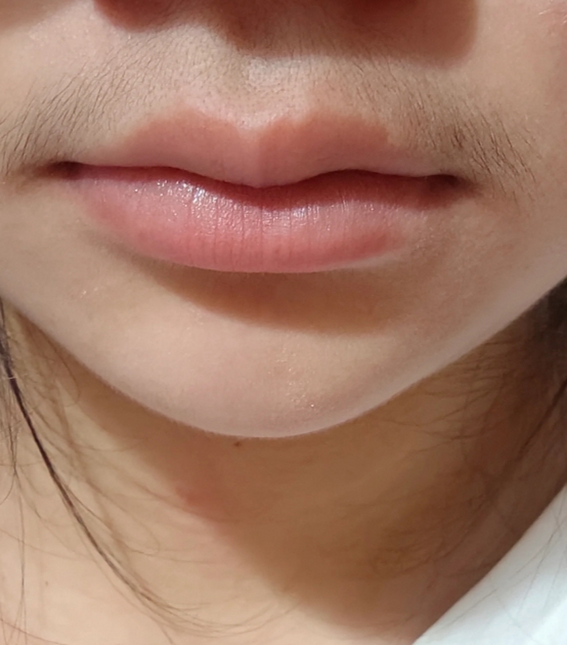 唇毛如何永久去除 #医美科普挑战赛#  唇毛是许多女性困扰的问题之一