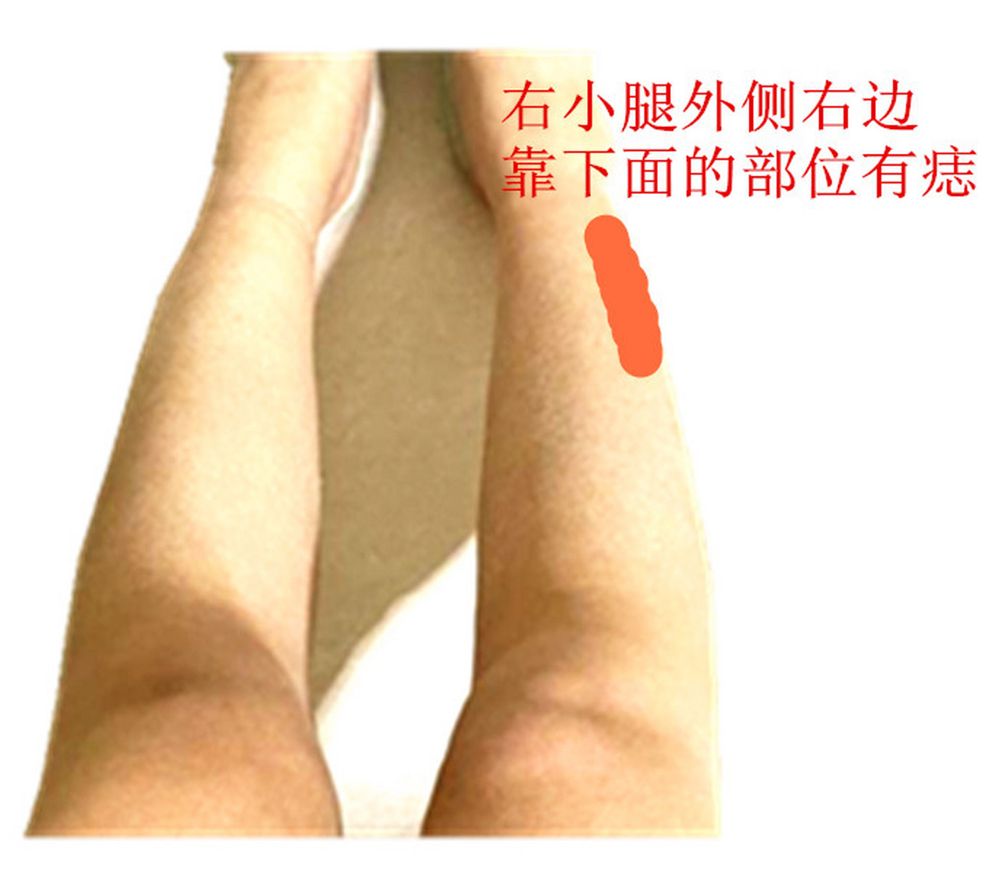小腿上的痣 很多人小腿是长有痣,有的正面上,有的在小腿肚上,有的在