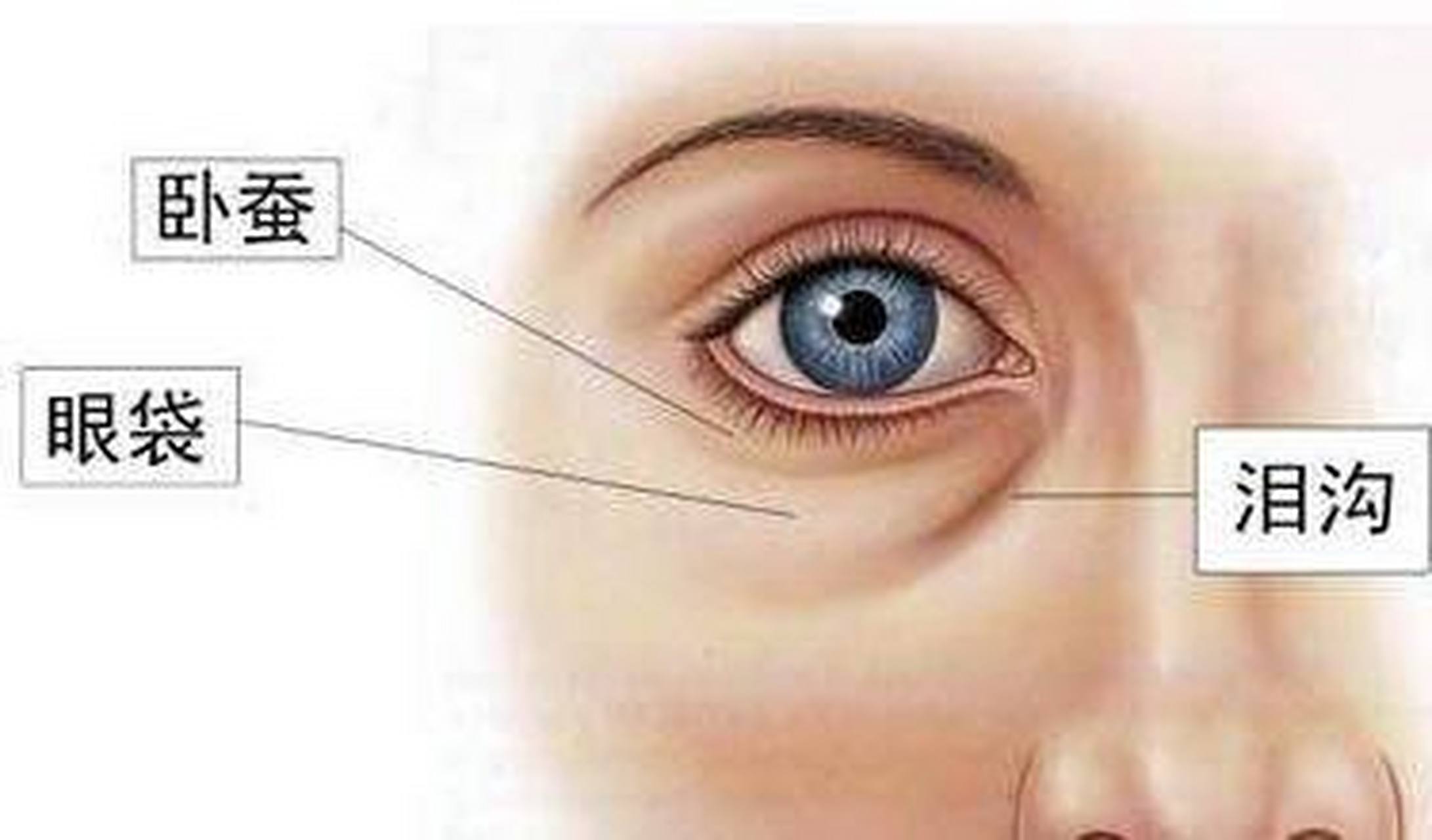 泪沟凹陷是由于苹果肌脂肪随着衰老,地心引力等作用而发生下移,泪档