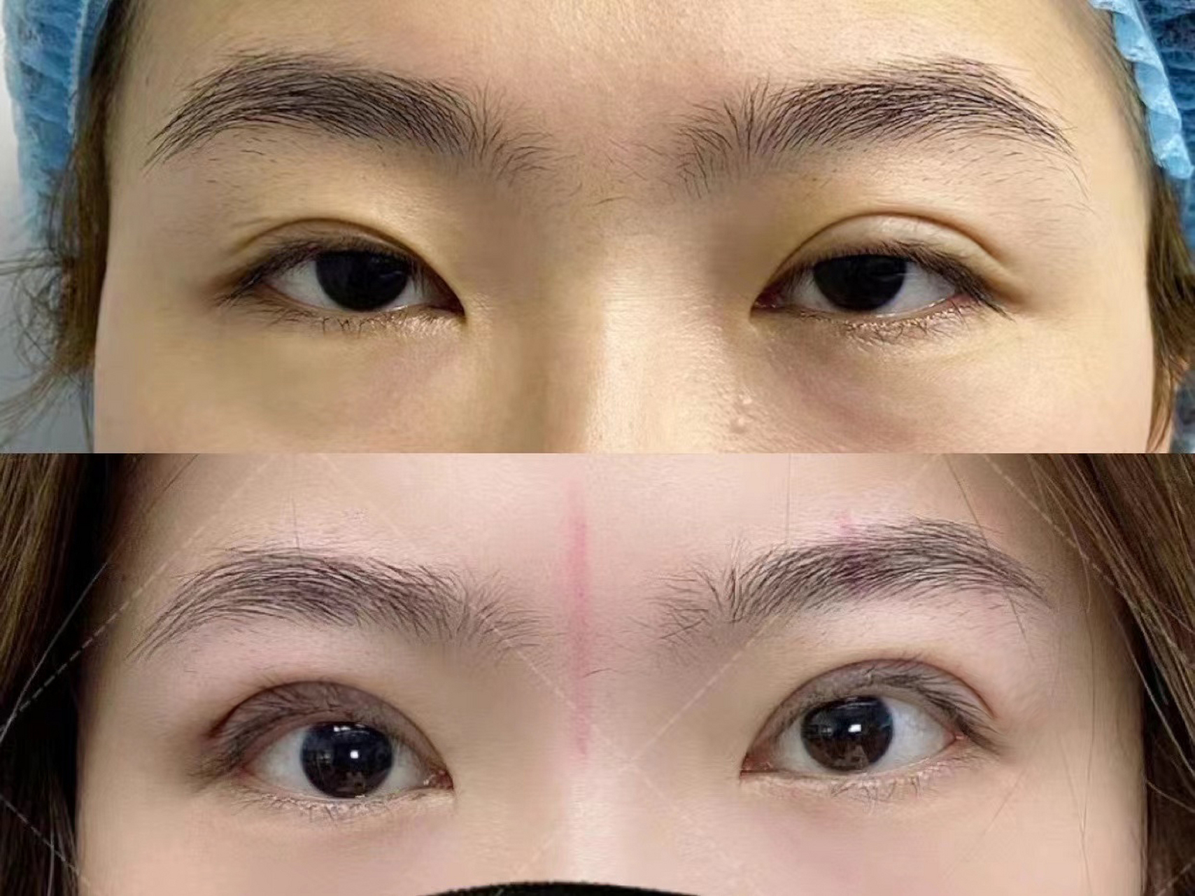 上睑下垂肌无力,割完双眼皮精神多了 初眼状态还是比较差的,脂肪偏多