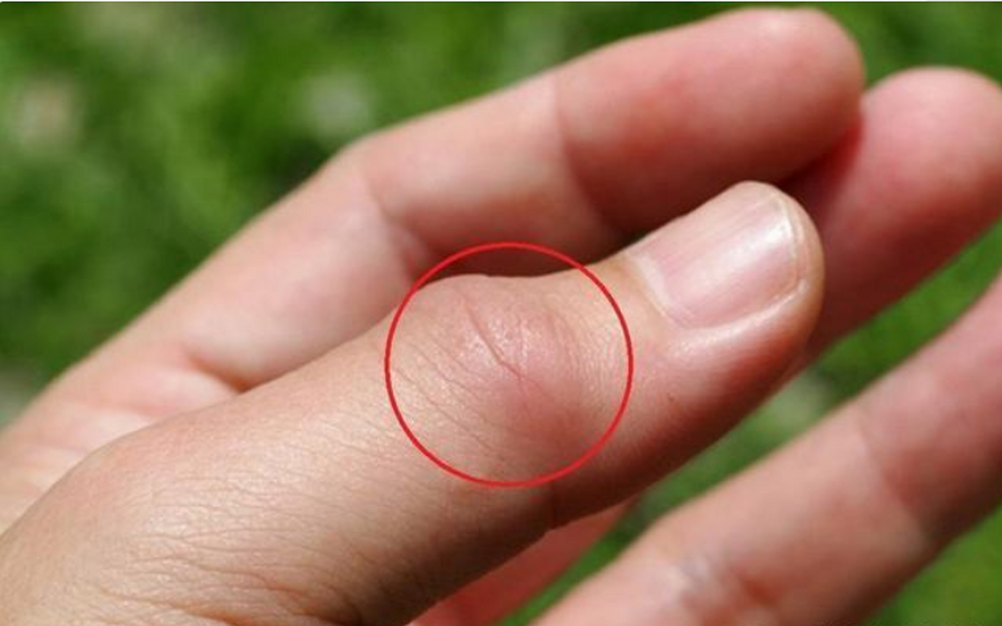 高尿酸者,手指若出现这种异常,最好去检查下!痛风多半已找上你!