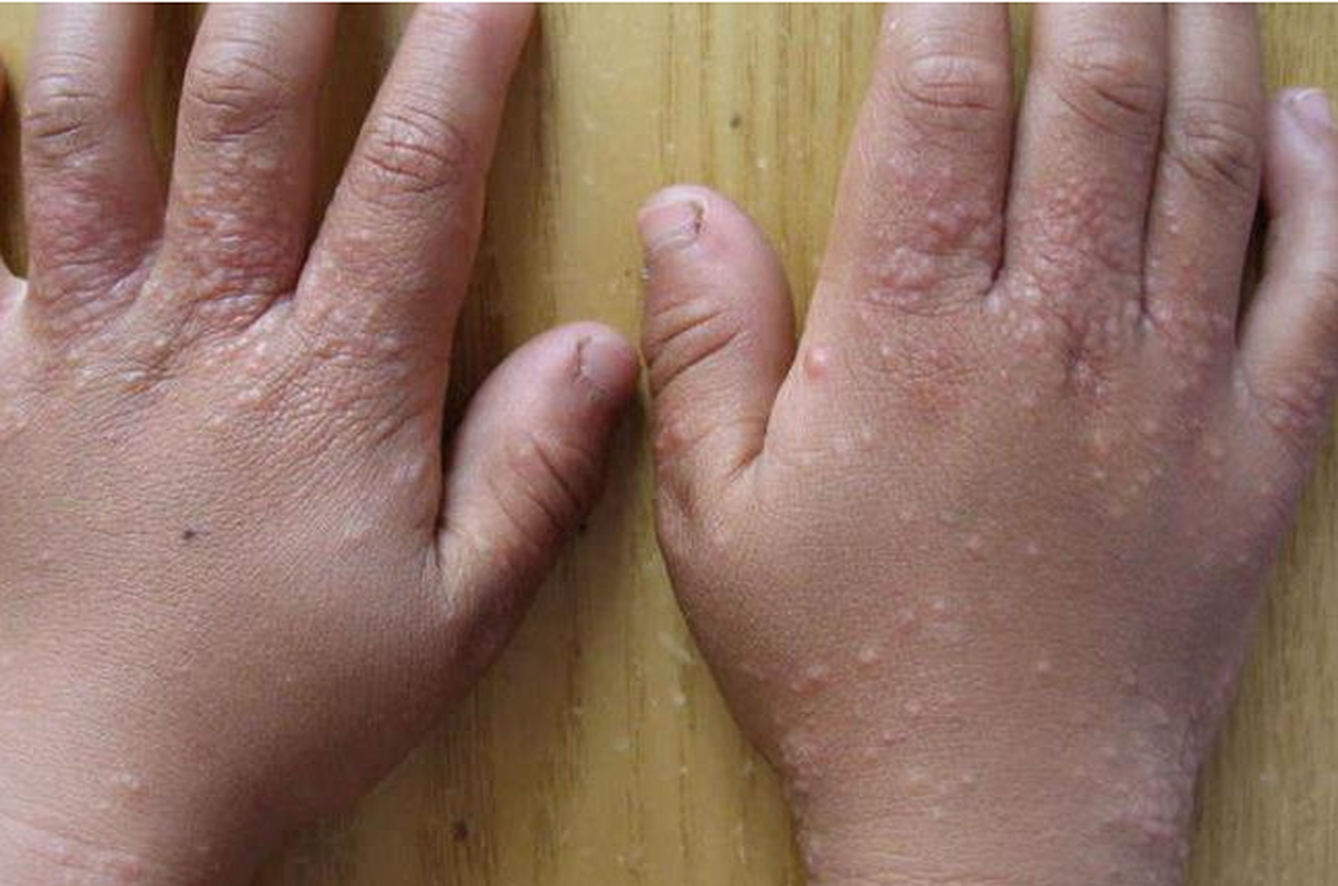 鲍奶奶您好,孩子手上长的疹子是什么,您能帮我看看吗?