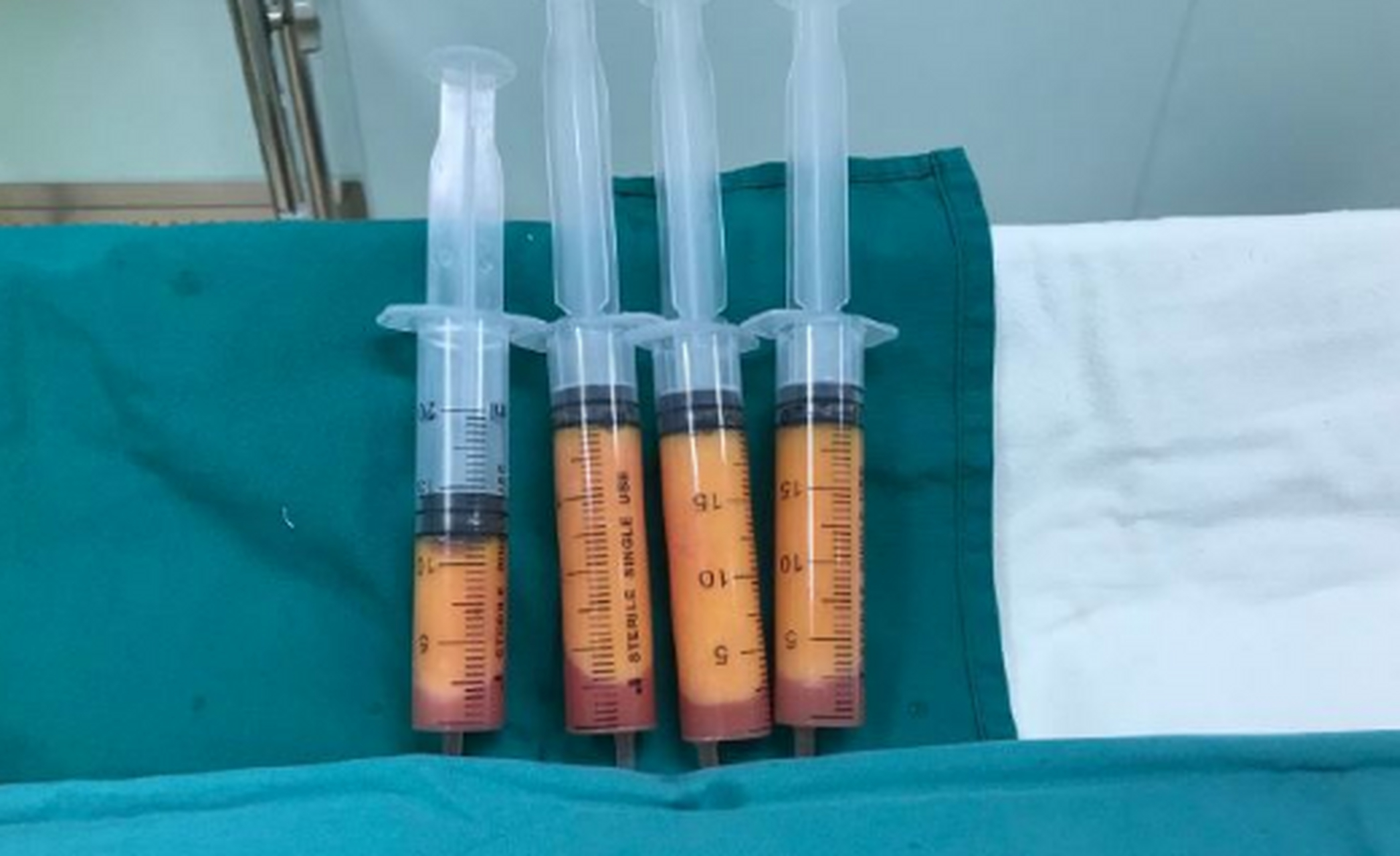 面部吸脂#  刚结束一台面吸手术 这个妹子脸上脂肪特别多 脸和脖子都