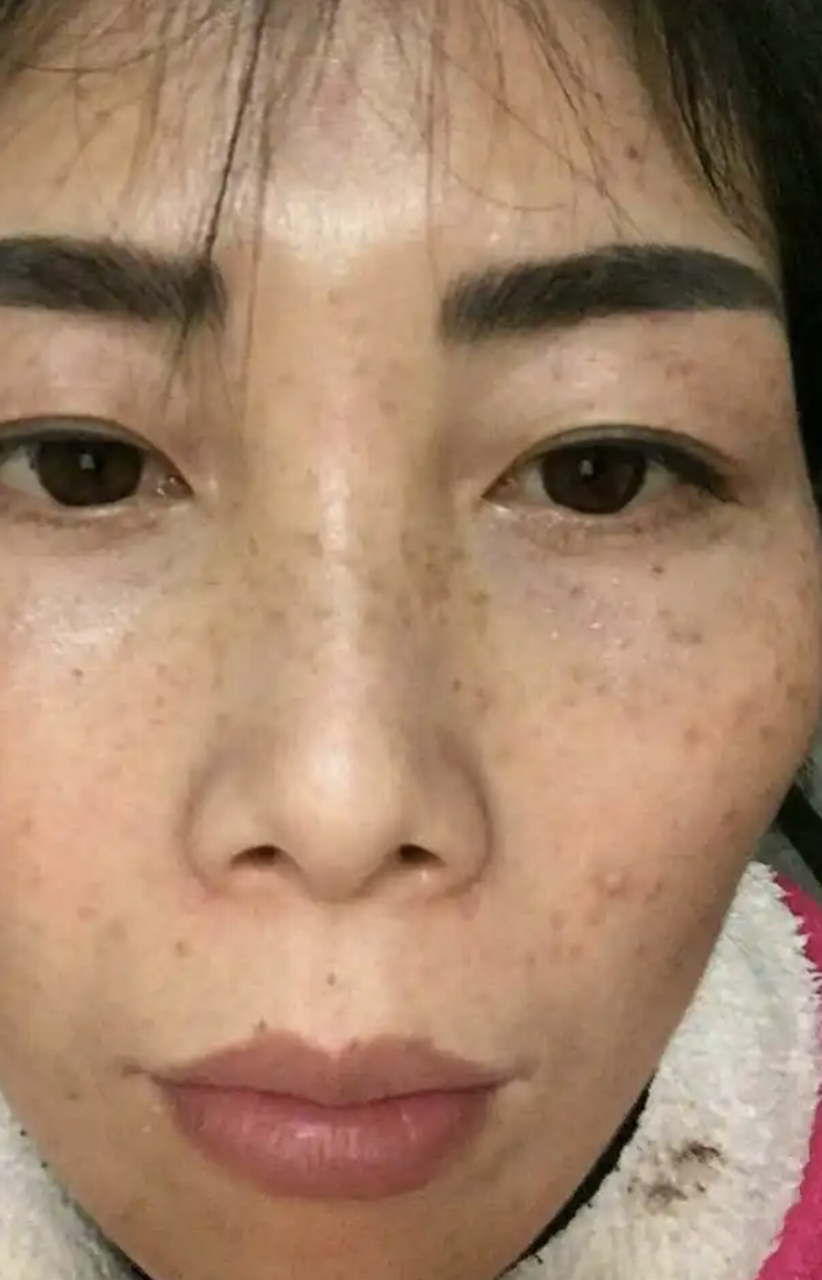 激光祛斑# 黄褐斑有办法去掉吗 黄褐斑是一种常见的色素沉着性皮肤病