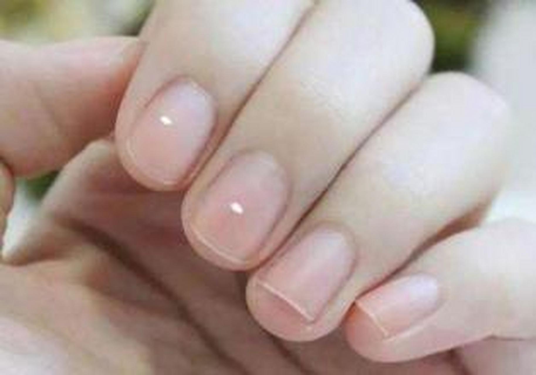 指甲上的白色小斑点叫「点状白甲症」,绝大部分是因为