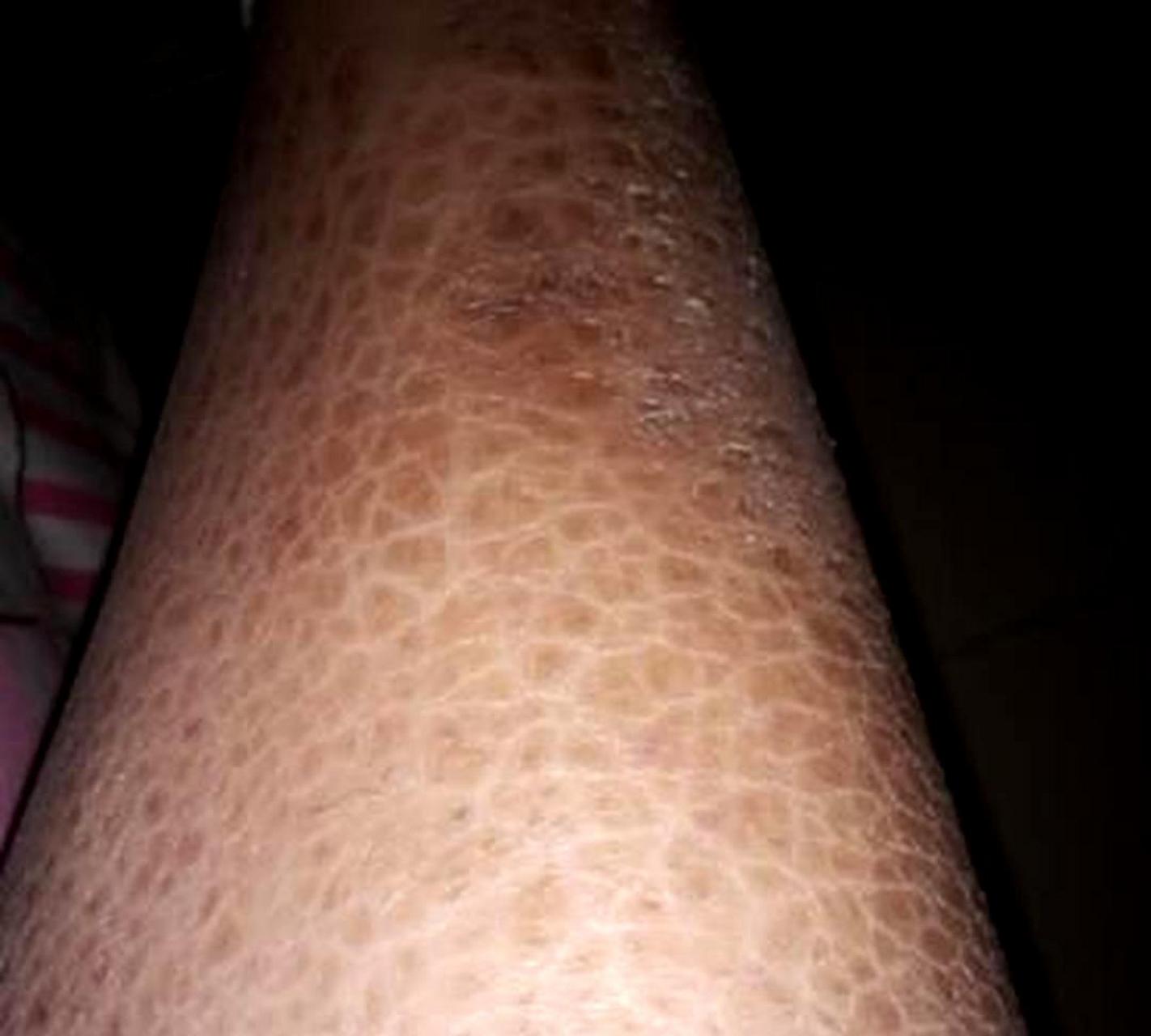 昨晚腿痒,今早发现皮肤出现这种情况,请问还有治疗的方法吗?