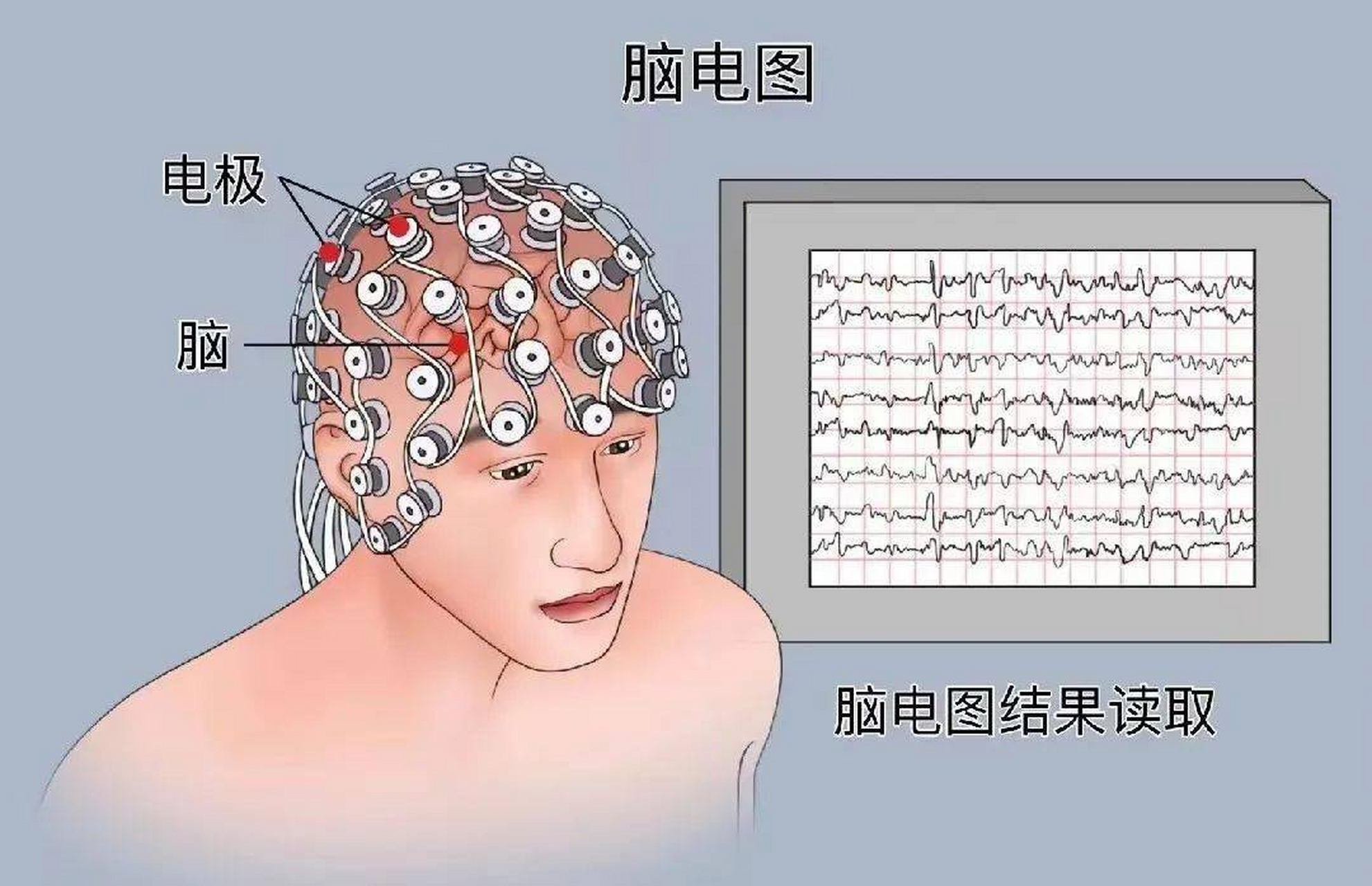 睡眠障碍常常伴随着特定的脑电图模式和睡眠阶段的异常.