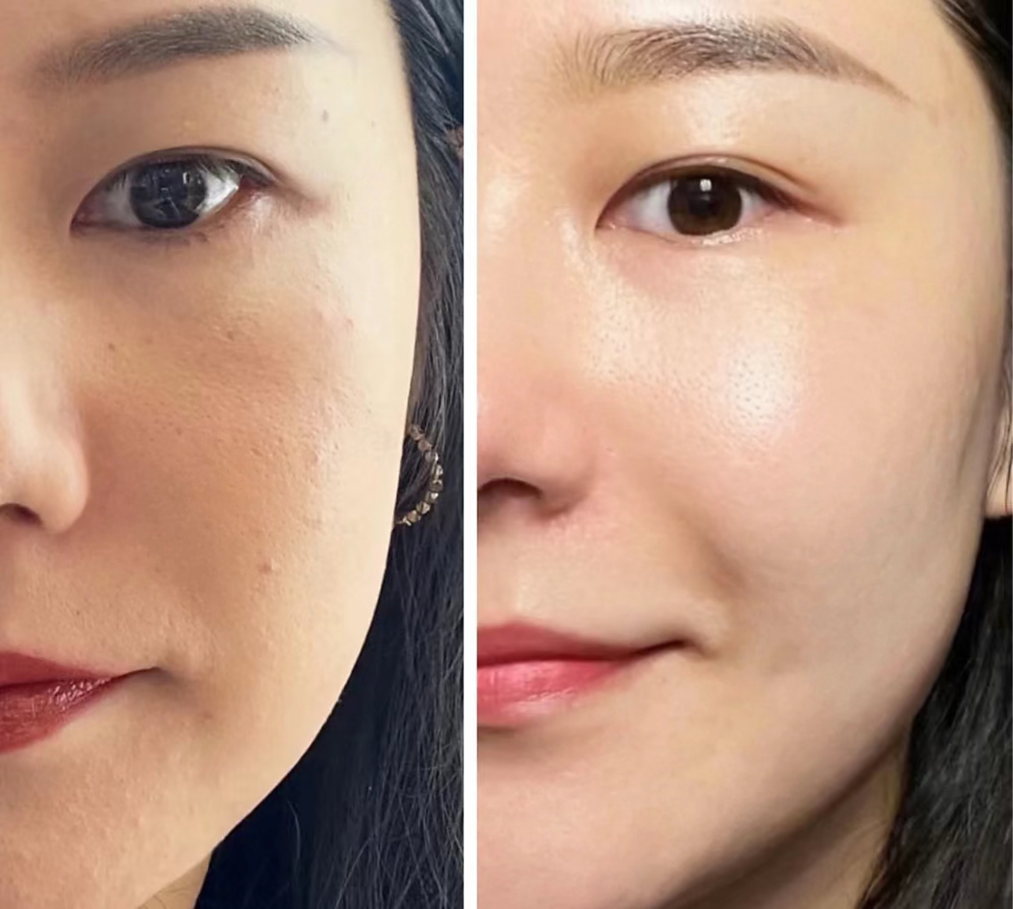 打完水光针多久可以正常护肤?