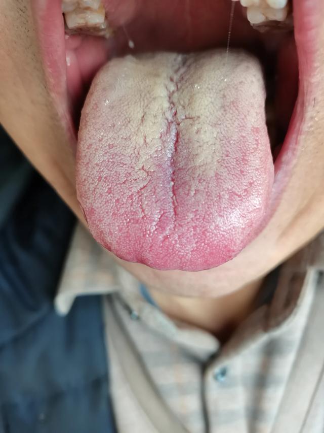 这舌头,除了热,就是湿了  脾胃湿热,肝胆湿热,下焦湿热,心火旺  但凡