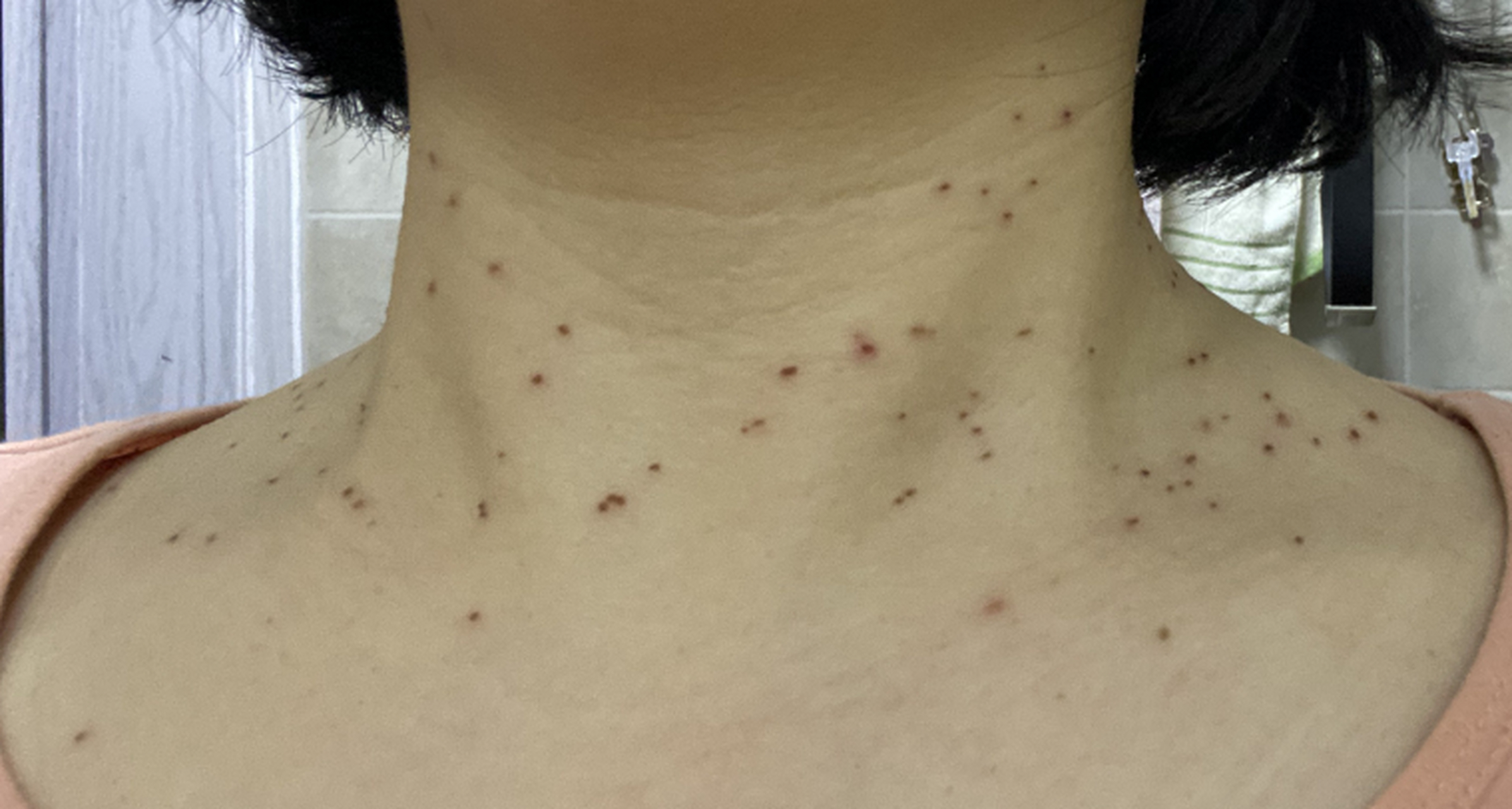 我今年55岁,再婚一年,2个月前,脖子长了几个肉疙