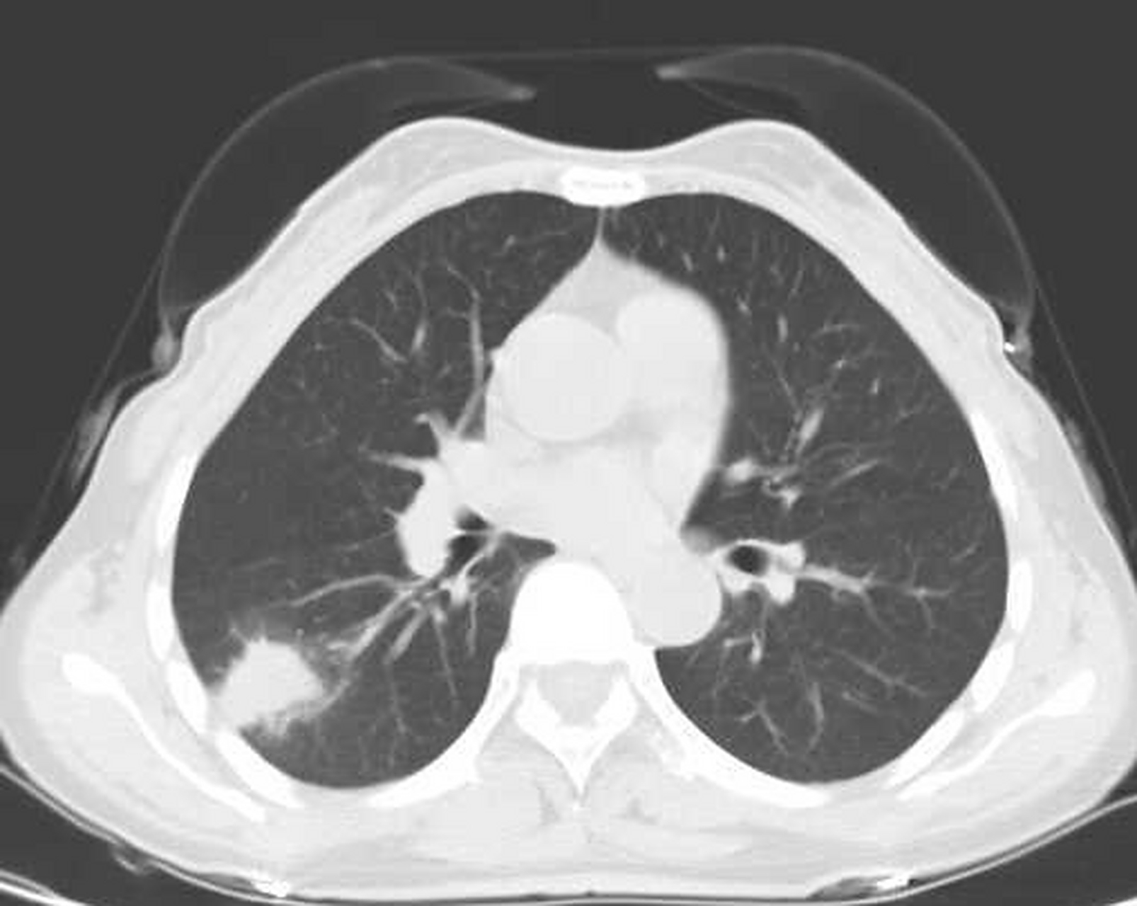 希望你的肺部ct永远不会出现这8种情况:  1,右肺下叶胸膜下可疑磨玻璃