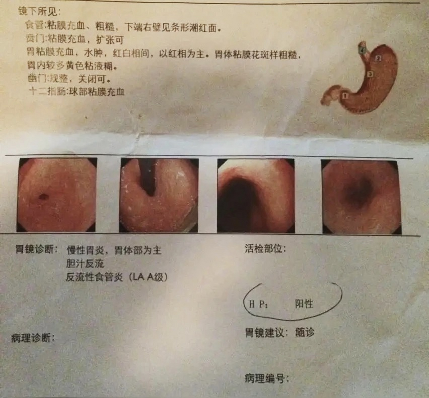 两年前患者因胃部不适,检查为胆汁反流性胃炎.