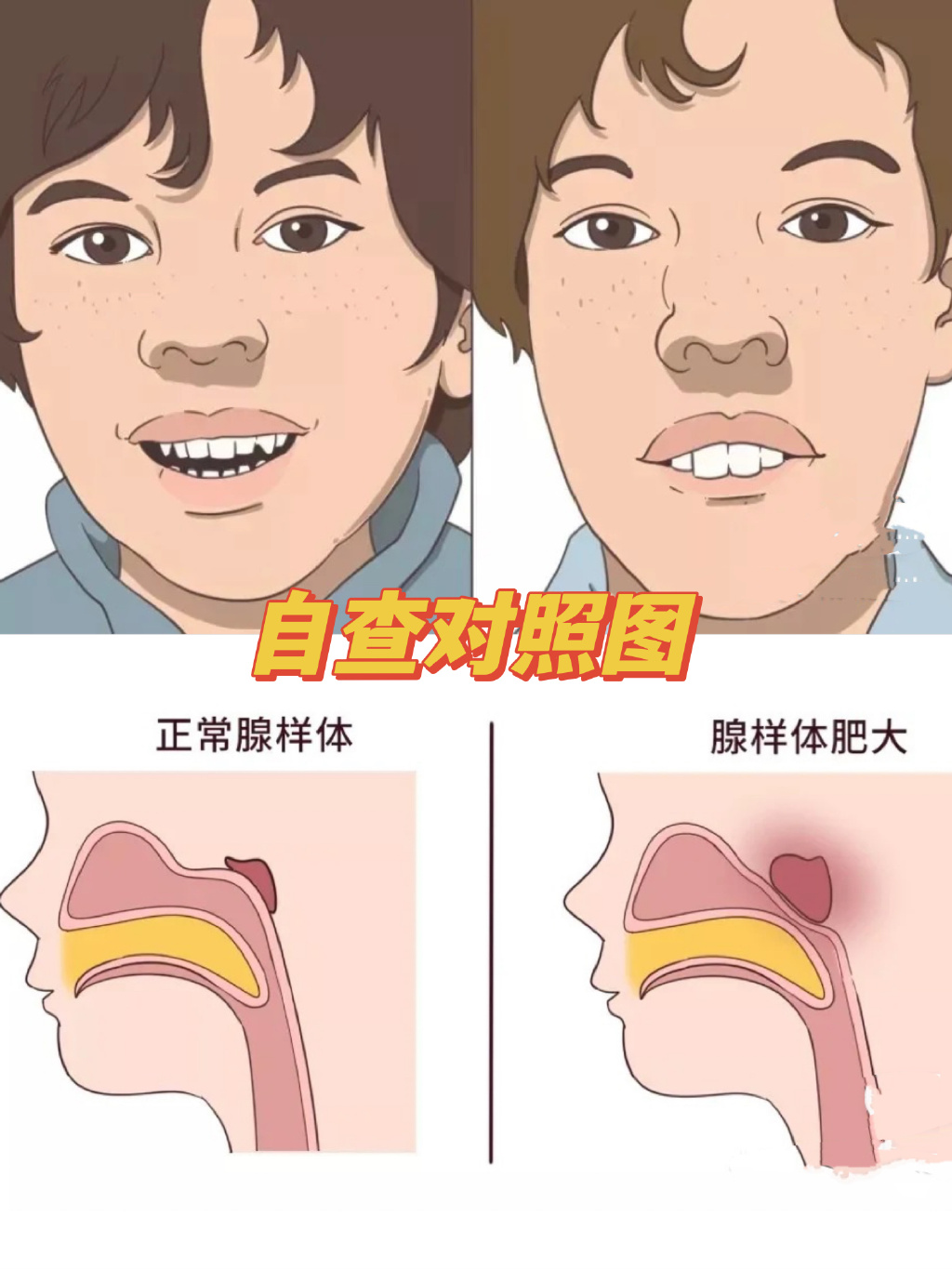 治疗腺样体肥大图片和正常图片腺体肥大有哪些表现腺样体肥大的症状