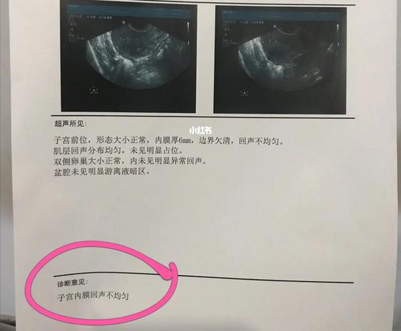 3,检测看宫内环境,大小内膜厚度,子宫发育是否正常,宫腔内是否有纵隔