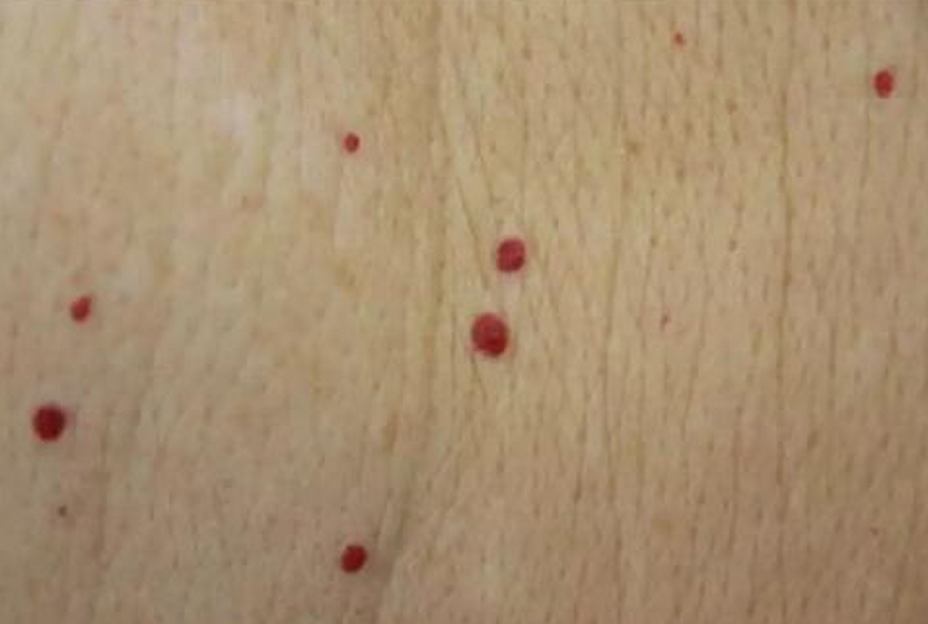 47岁邓先生,最近身上长了很多小红点,不痛不痒的,就是越长越多,邓先生