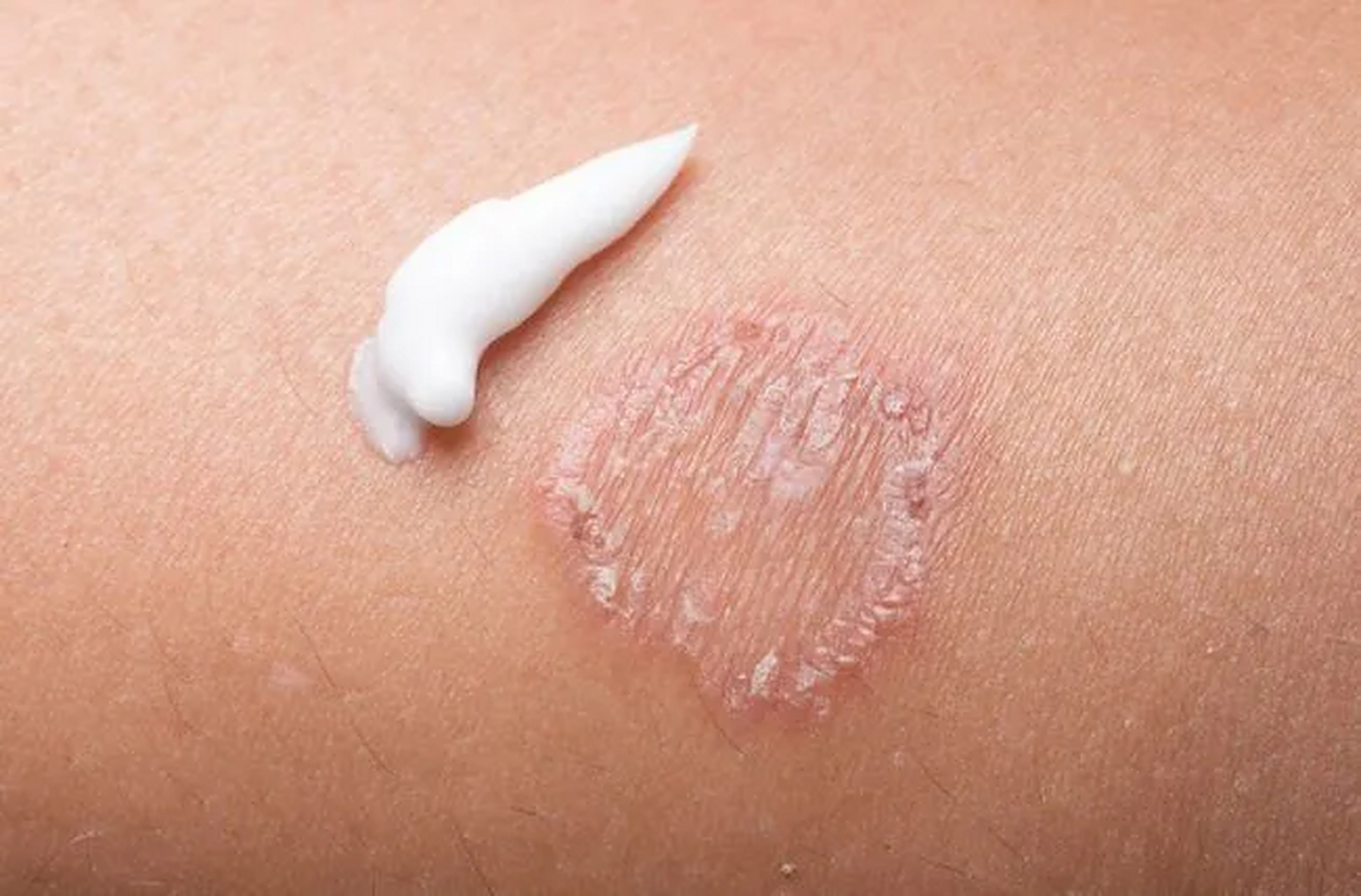 癣和皮炎湿疹经常容易搞混, 一个典型的症状有助于区分什么是癣.