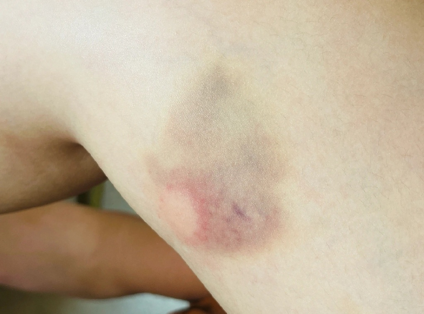 蚊子把我腿上的淤血吸走了