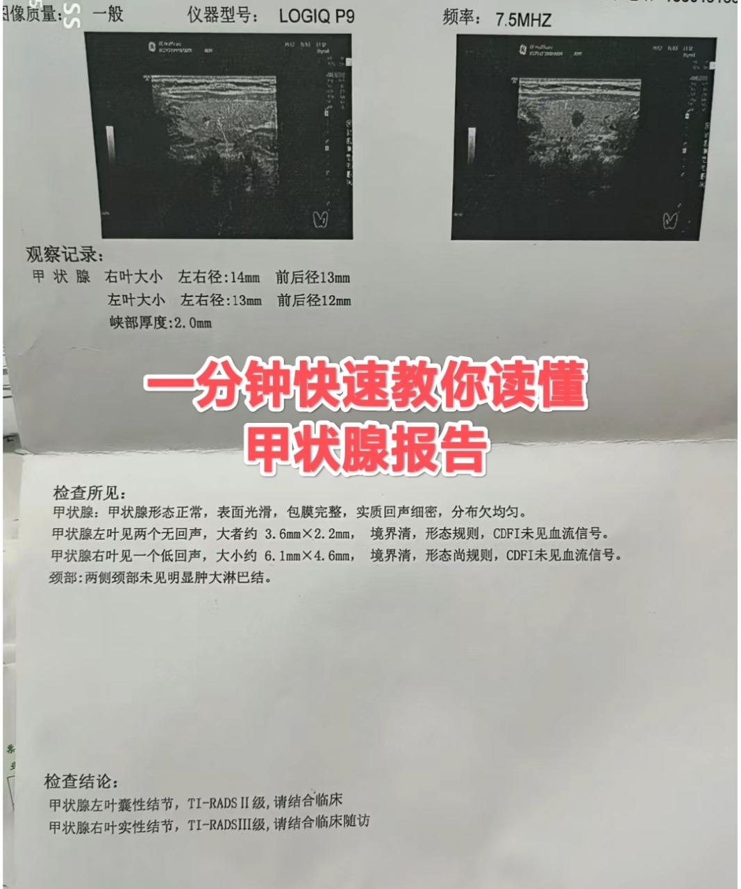 低回声,就是一个实性的的结节,如果是一个无回声,代表是一个囊肿. 2.
