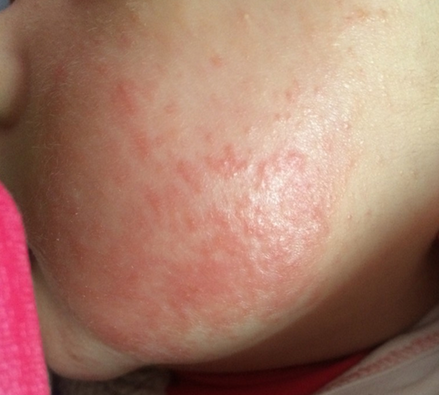 正确认识"婴幼儿湿疹"