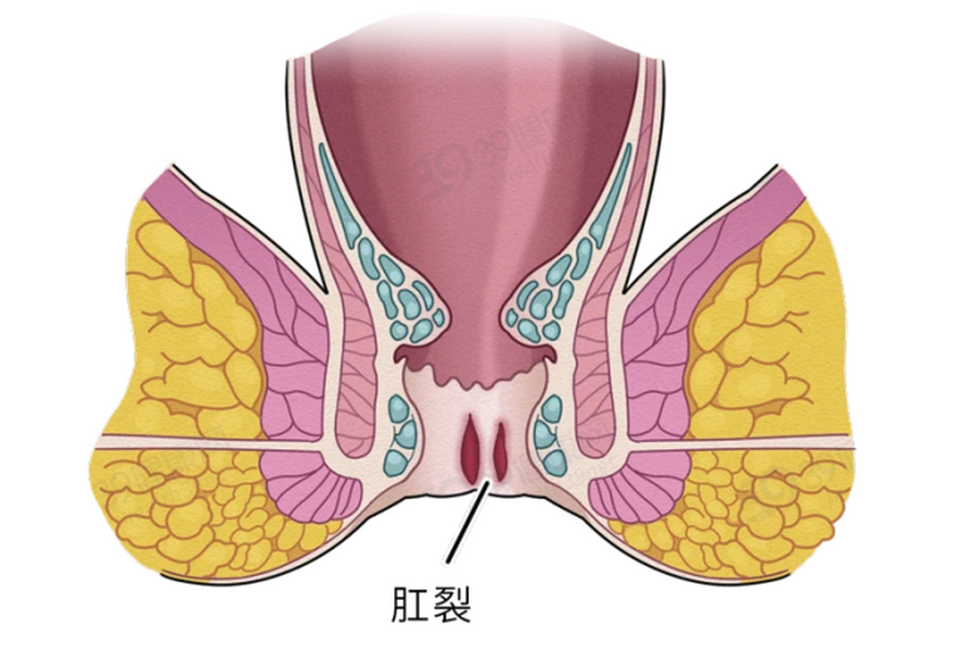 #肛裂# #肛瘘# 得知自己是肛裂继发感染而引起肛瘘时,韩先生很是惊讶.
