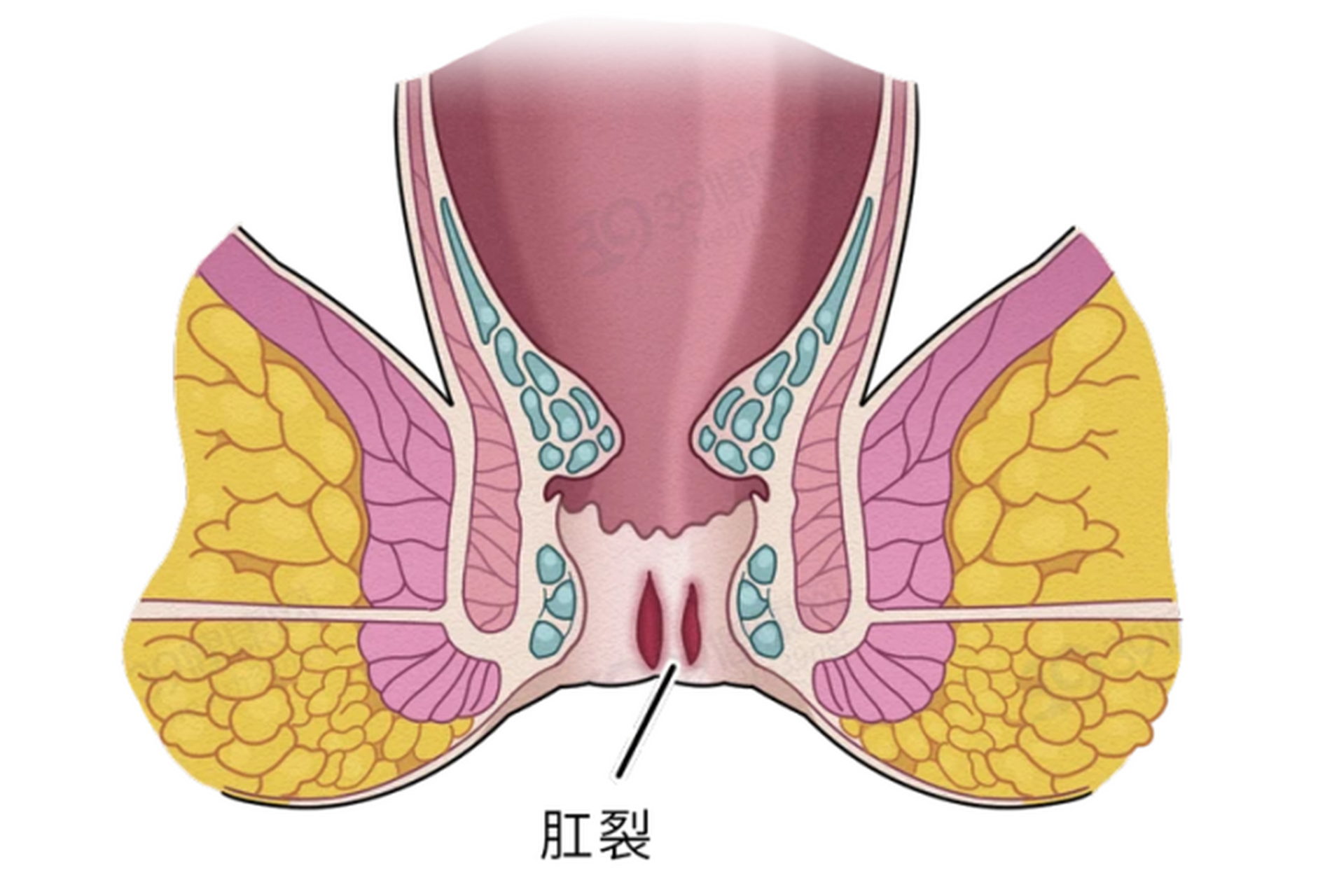 肛裂在什么位置图片图片