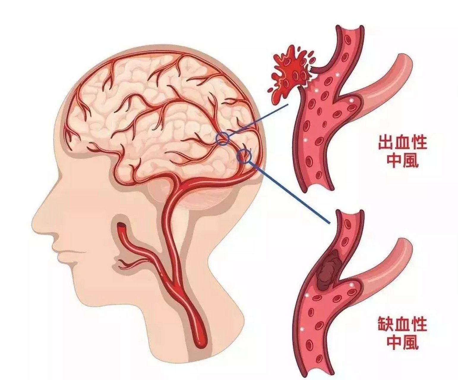 血管堵塞,一个主凶,四个帮凶  血管堵塞发生心脑血管疾病,有一个主凶