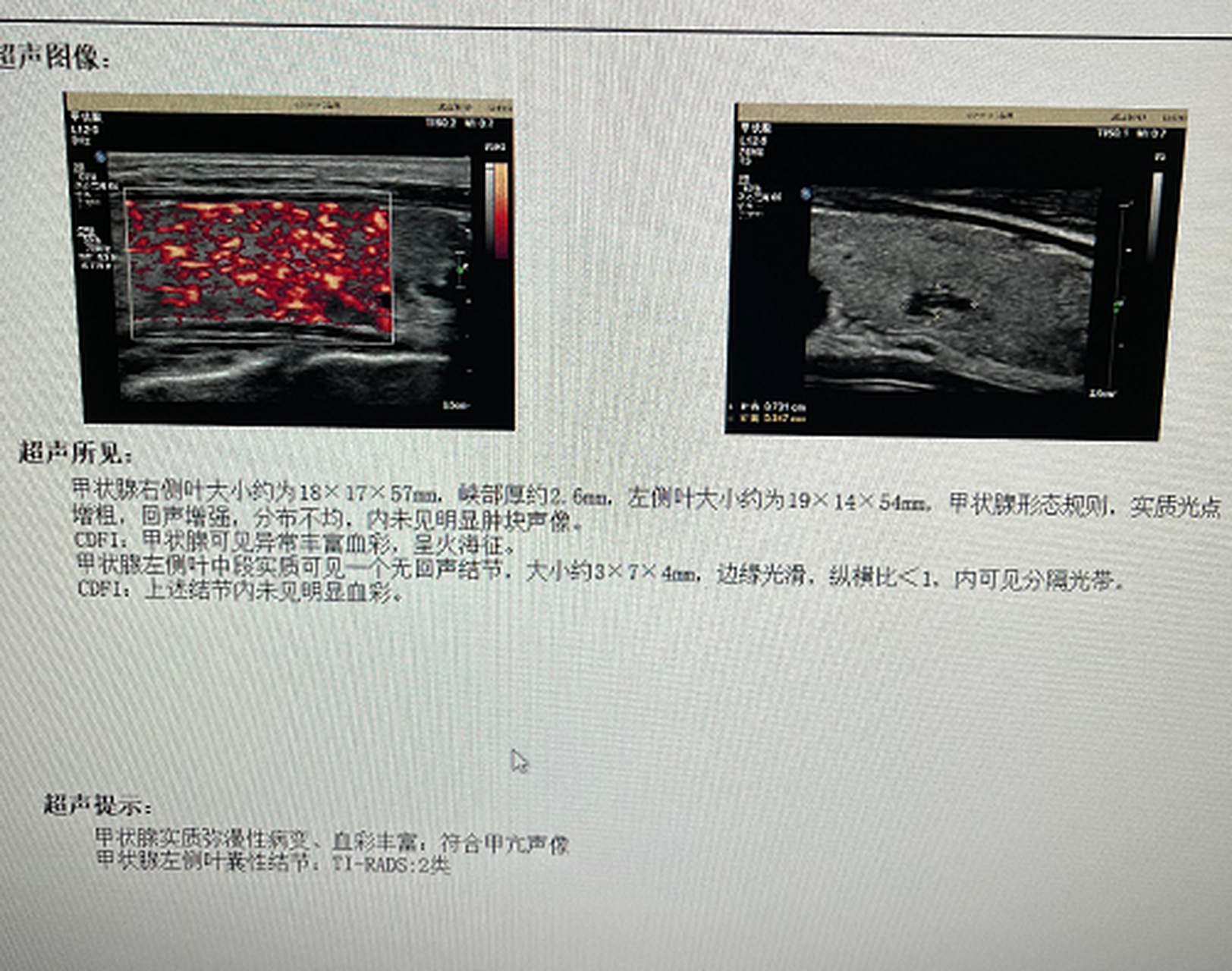 原发性甲状腺功能亢进症,也称为graves病.