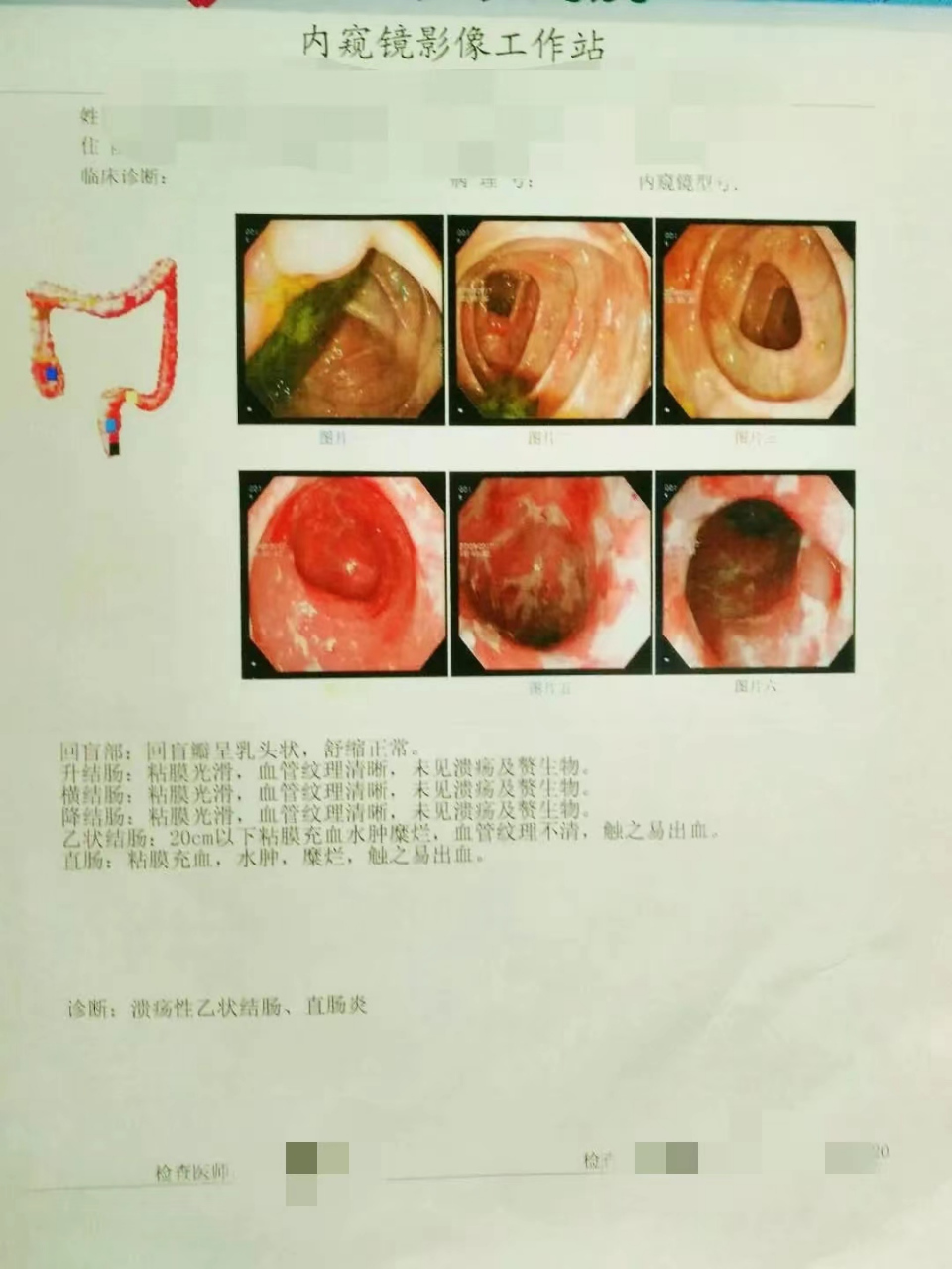 乙状结肠炎症图片