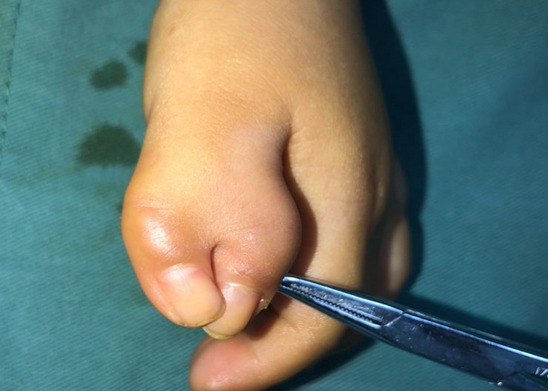 iv-d型复拇,俗称蟹钳样多指畸形,这类畸形的两个拇指像蟹钳一样,彩乔