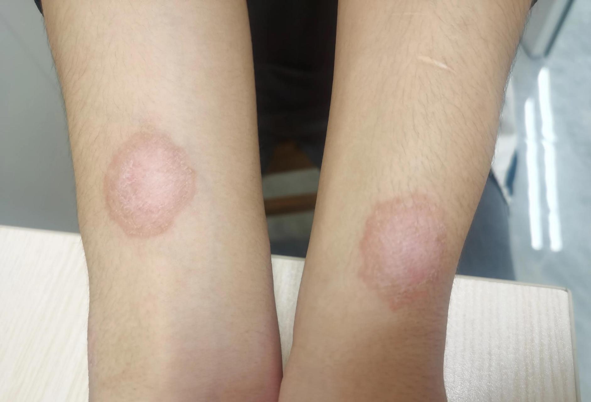 手臂上两个疹子,很对称.