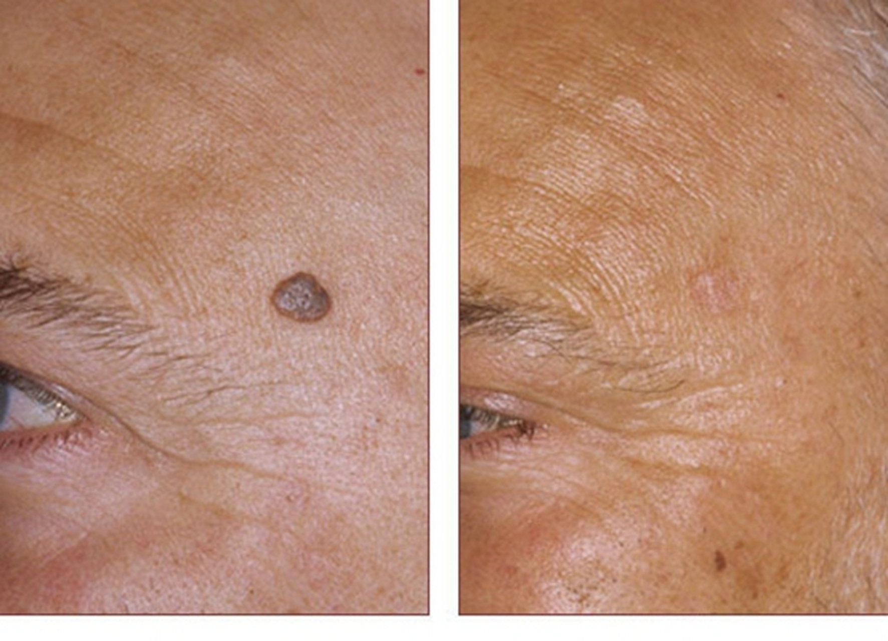 皮肤长了痣,要不要去掉?