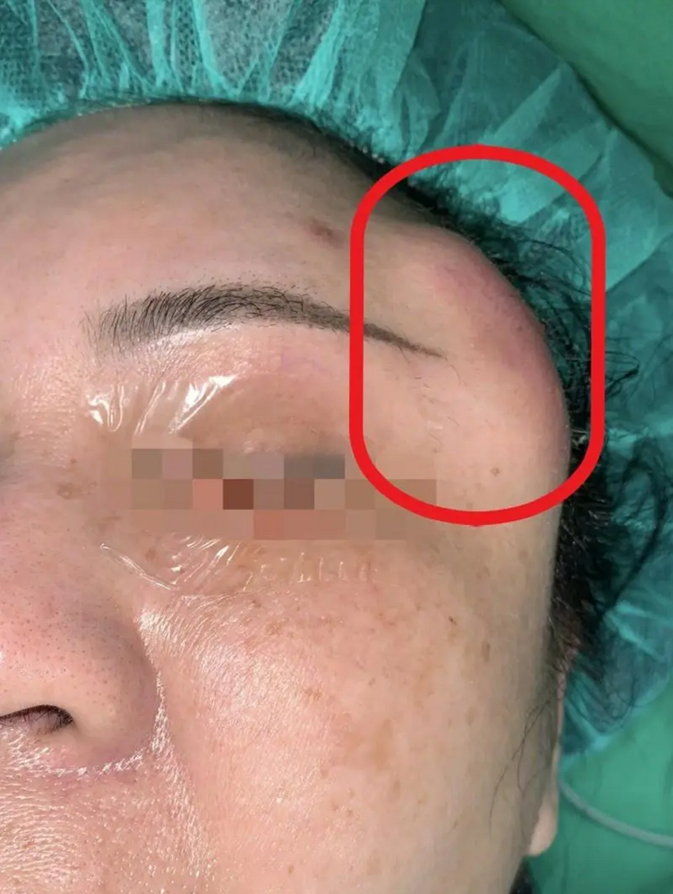 奥美定取出需要注意什么,在面部和胸部都需要着重注意什么!