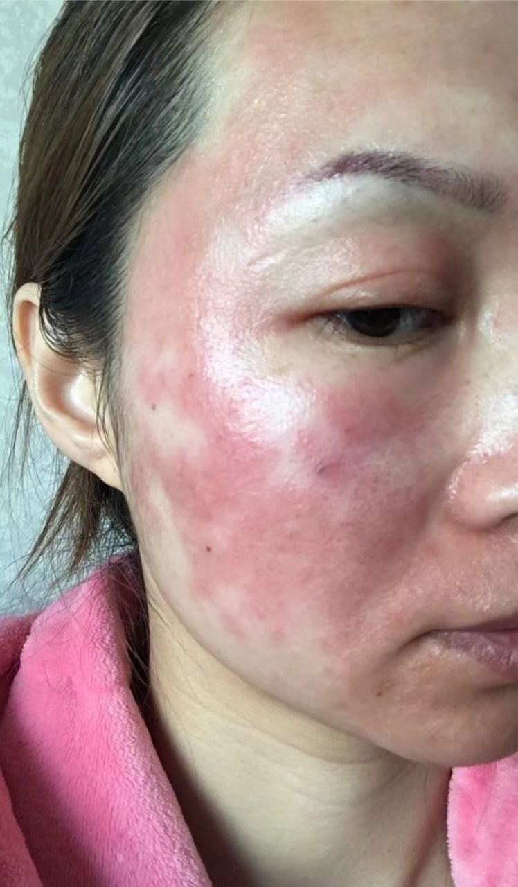 1,不要乱用激素药 当出现激素脸时,为了让皮肤尽快恢复正常,必须