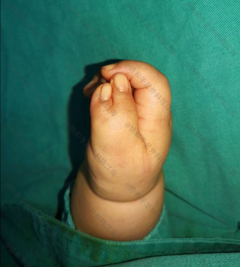 为什么六指孩子聪明