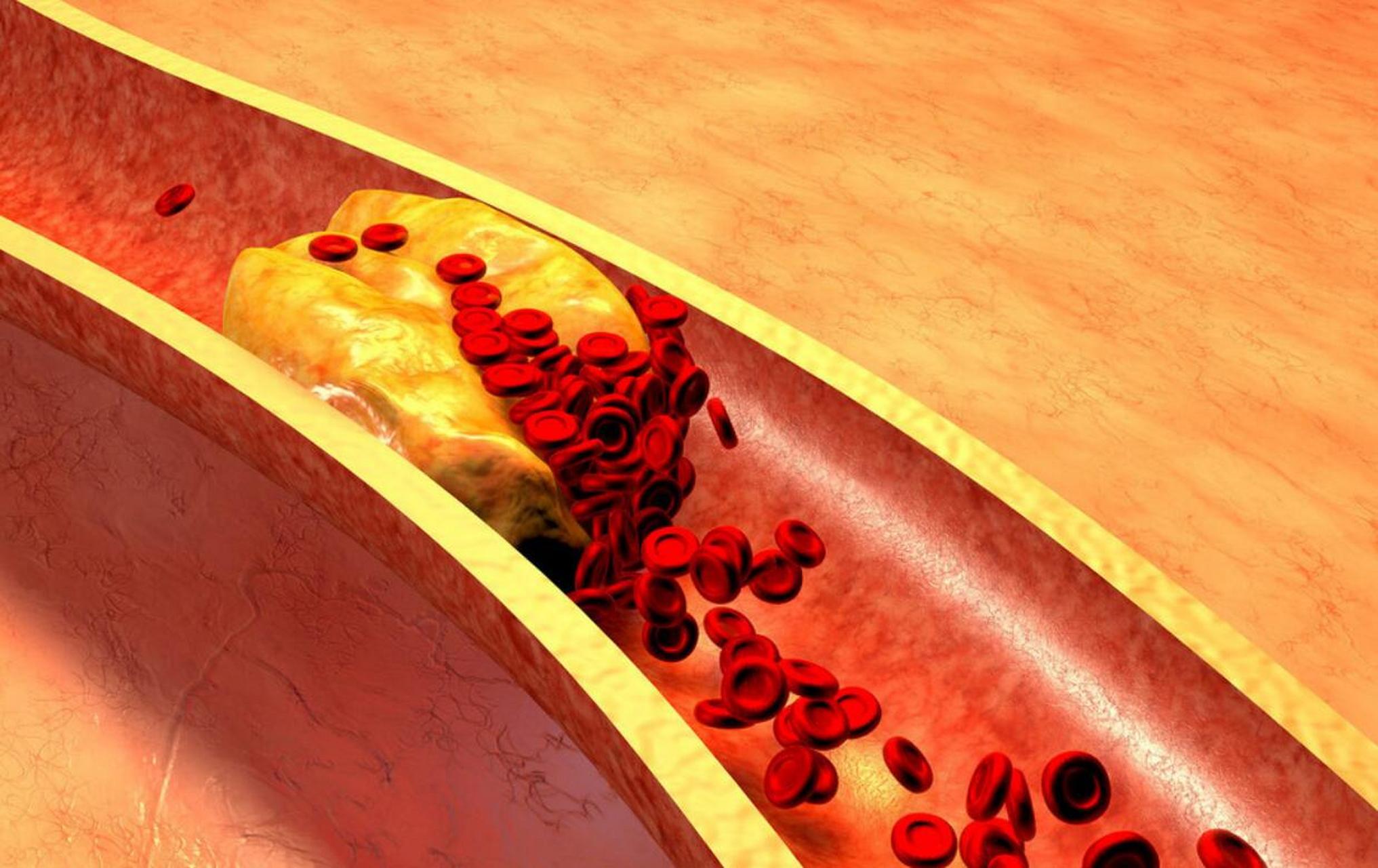 预防动脉硬化 血管狭窄,这几个指标要控制好 血管老化是许多心脑血管