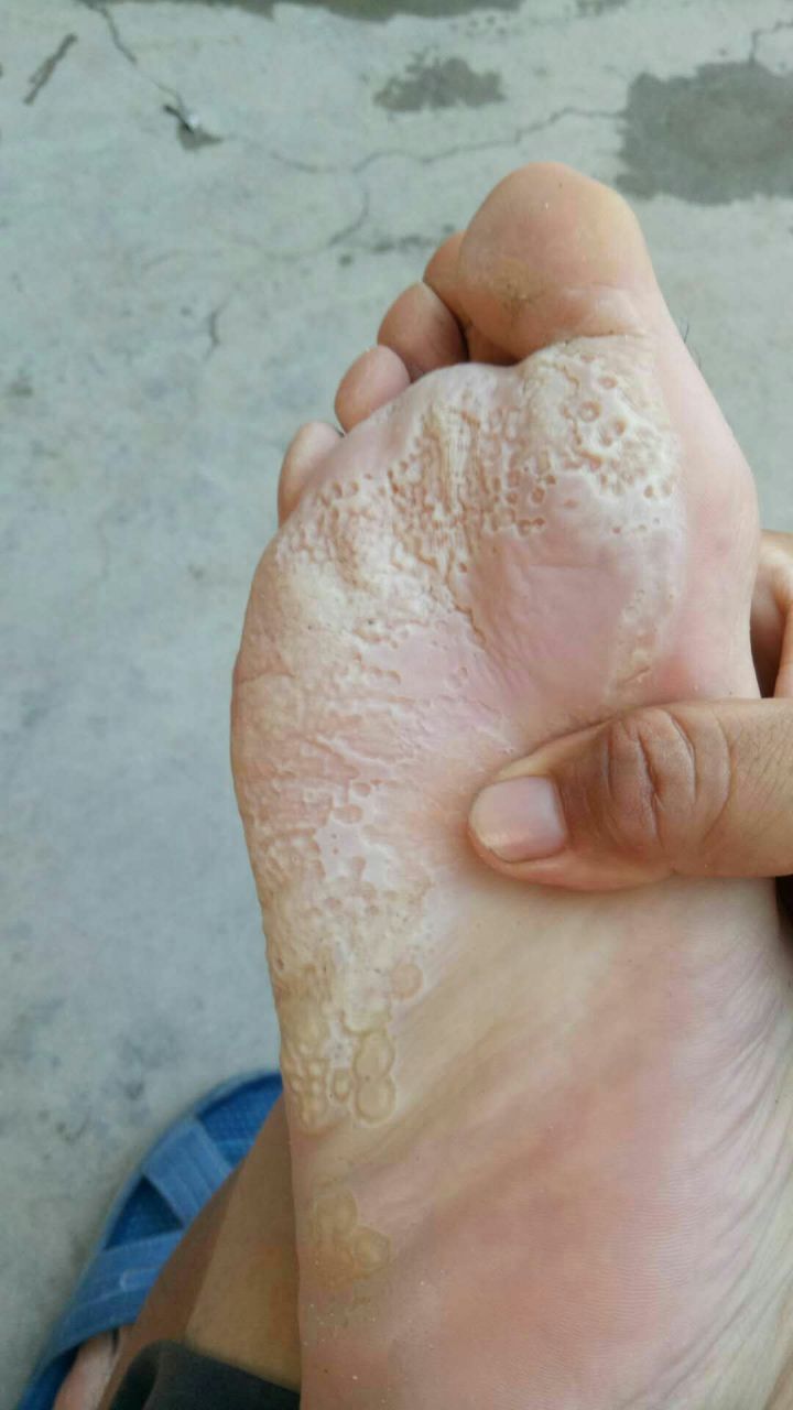 如果你的脚底有这样的蜂窝状小孔,出汗后还特别臭!别再当脚气治了!
